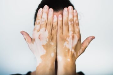 Emiratos Árabes Unidos, el primer país en aprobar uso oral de medicamento para vitiligo